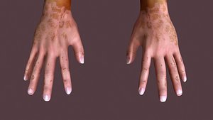 3D Vitiligo Leucoderma skin disease