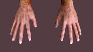 Vitiligo Leucoderma skin disease