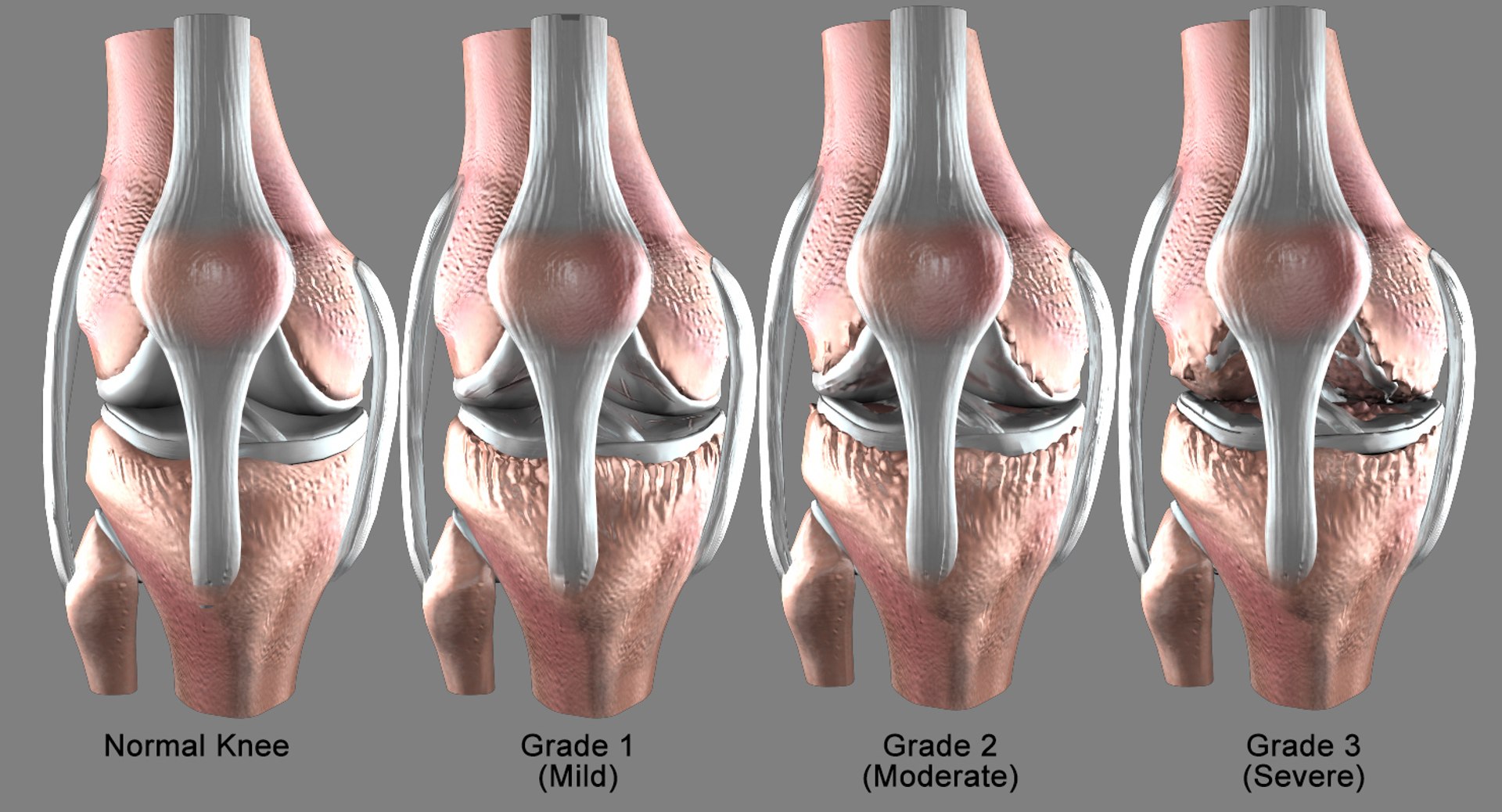 Osteoarthritis Severe Condition Knee 3D Model - TurboSquid 1410244