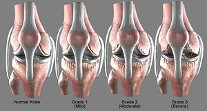 osteoarthritis severe condition knee 3D model
