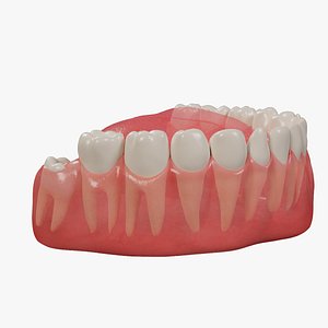 3D Impacted wisdom teeth