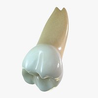 Upper Third Molar (wisdom)