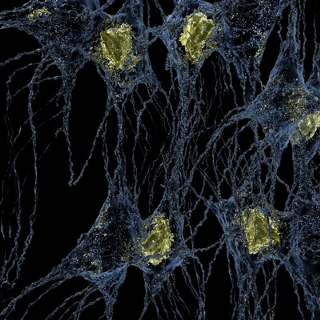 Brain Tumor 3d Model
