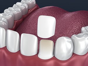 dental veneer preparation instalation 3D model