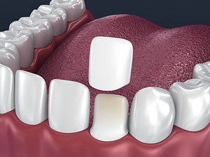 Dental veneer preparation and instalation