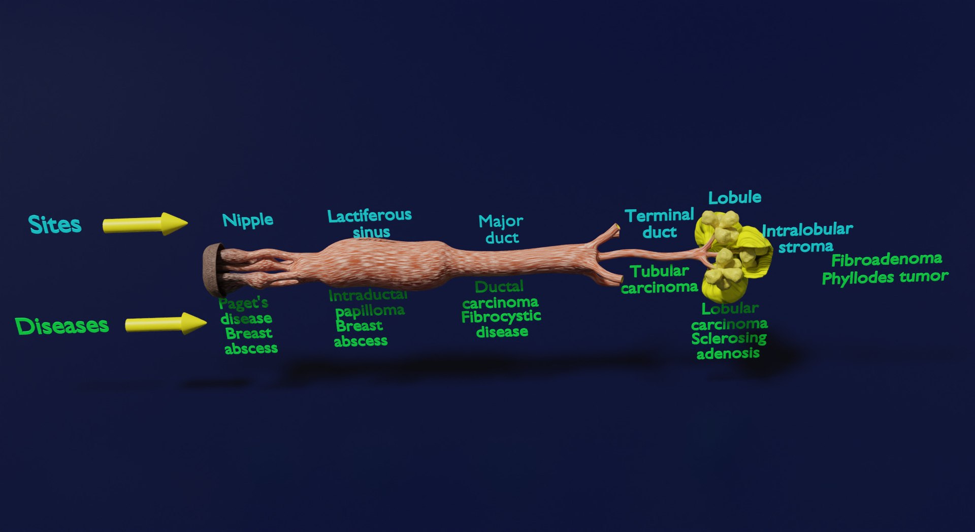 3D Breast Duct Sites And Diseases - TurboSquid 2112214