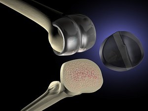 Knee replacement project cd4