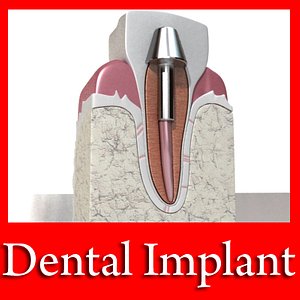 3ds dental implant