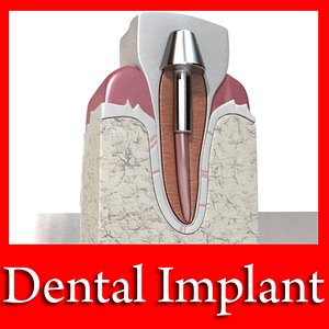 Dental Implant