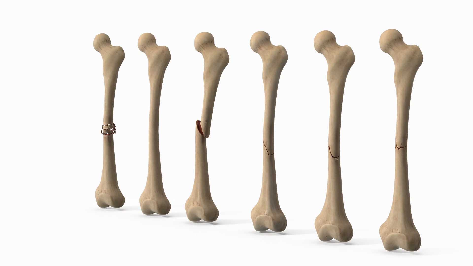 3D Bone Fracture Types Set model https://p.turbosquid.com/ts-thumb/oD/2ivzLc/CY/bone_fracture_types_set_360/jpg/1782796262/1920x1080/turn_fit_q99/b02d701e3b8102013b13b46415ccc29b59d64f3e/bone_fracture_types_set_360-1.jpg