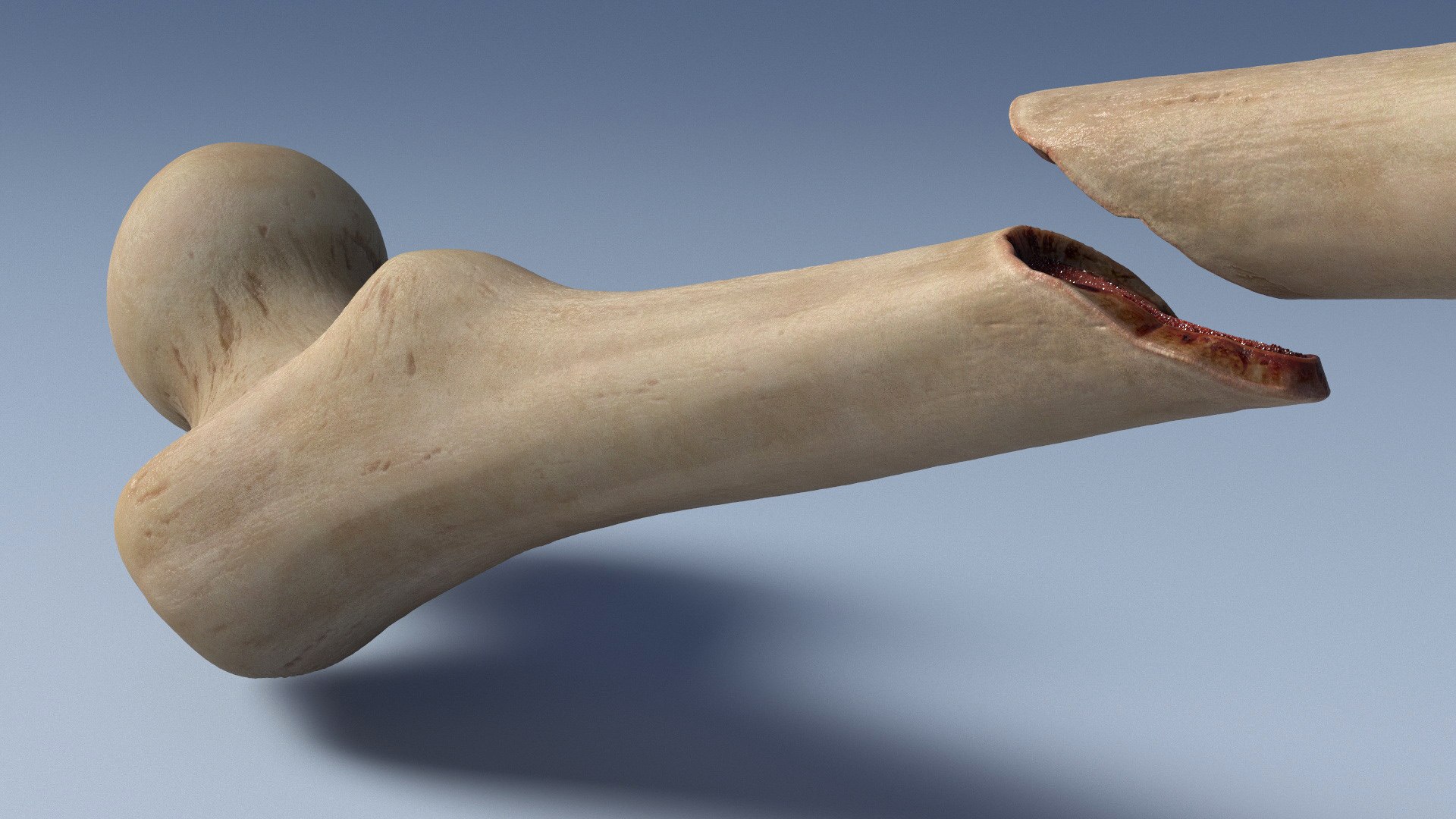 3D Bone Fracture Types Set model https://p.turbosquid.com/ts-thumb/oD/2ivzLc/KV/bone_fracture_types_set_005/jpg/1782796321/1920x1080/fit_q87/87609c24cb88cc0645d8a637a8b5a32ab78ffa44/bone_fracture_types_set_005.jpg