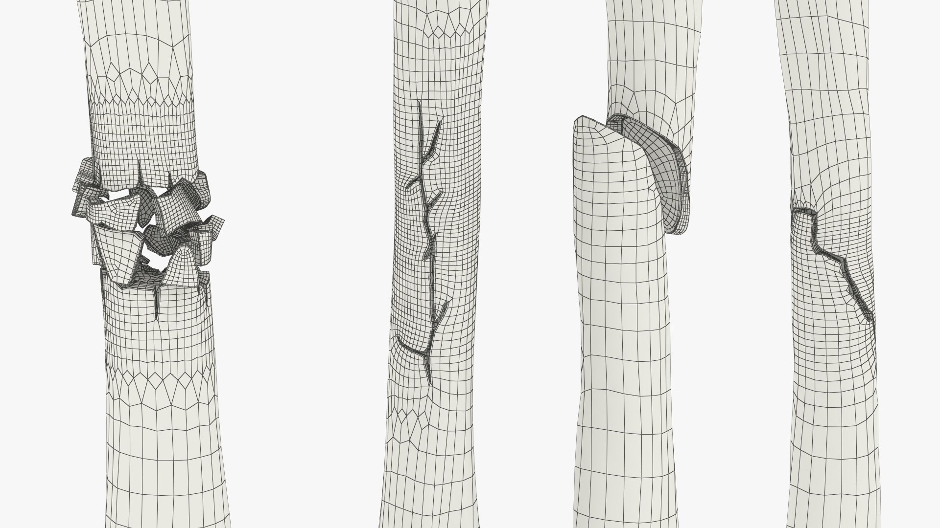 3D Bone Fracture Types Set model https://p.turbosquid.com/ts-thumb/oD/2ivzLc/dz/bone_fracture_types_set_014/jpg/1782796343/1920x1080/fit_q87/4d4c56b9fb3d0dbea7710bc1f22b22b344557ebd/bone_fracture_types_set_014.jpg