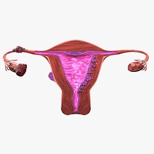 Uterus adenomyosis versus endometriosis 3d model
