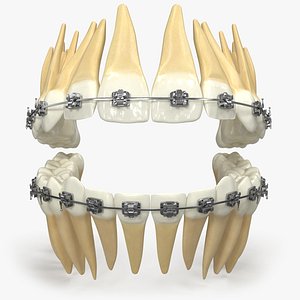 Human Permanent Dentition With Self Ligating Steel Dental Braces V01