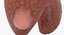 Papillary Cancer Thyroid