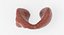 Papillary Cancer Thyroid