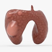 Papillary Cancer Thyroid