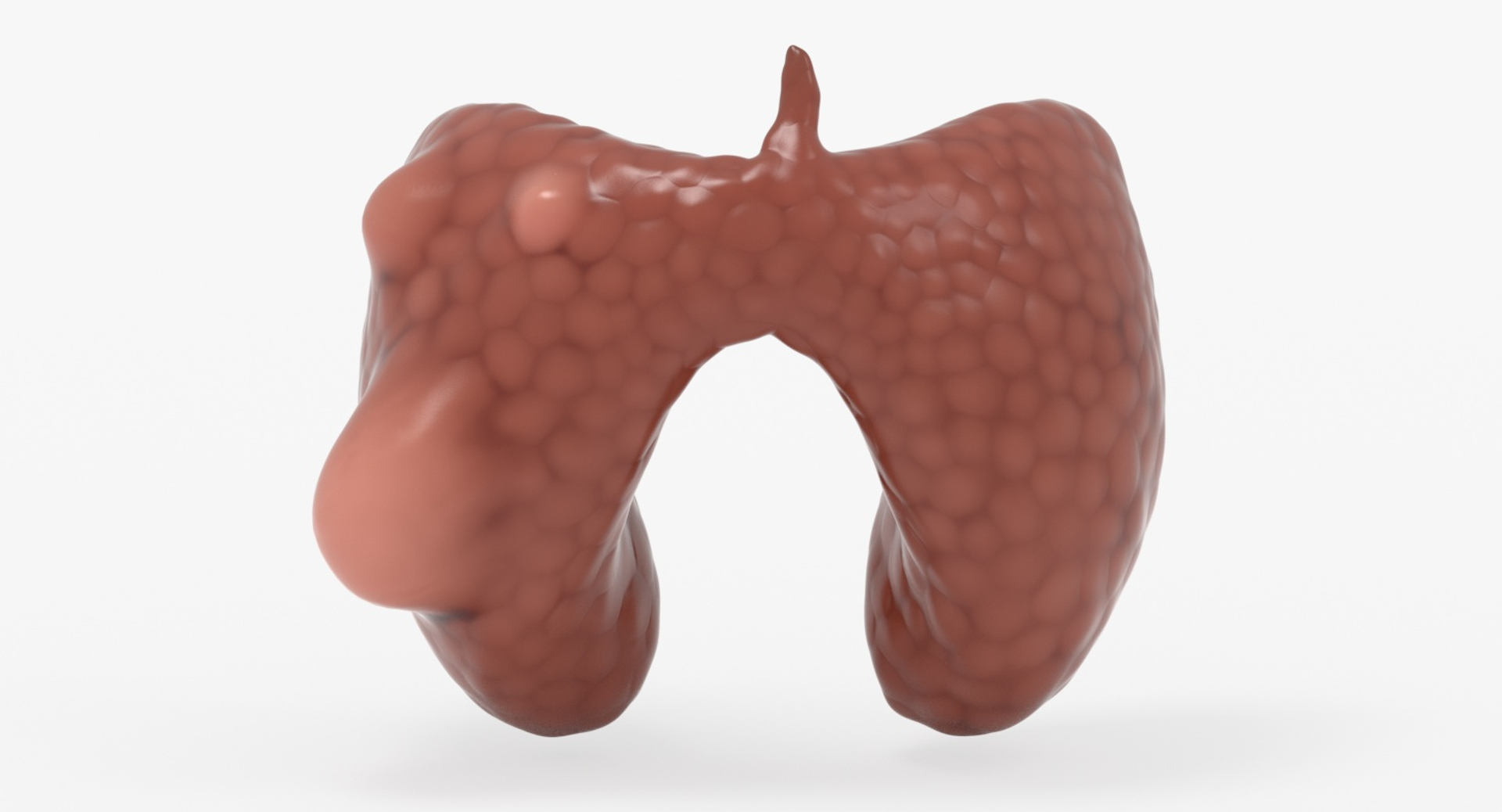 papillary cancer thyroid 3D model https://p.turbosquid.com/ts-thumb/oe/kvoIUx/oGCKRR6v/papillary_cancer_thyroid/jpg/1546076241/1920x1080/turn_fit_q99/85e29266be3f0d6ed944f2b1eed7758b09422816/papillary_cancer_thyroid-1.jpg