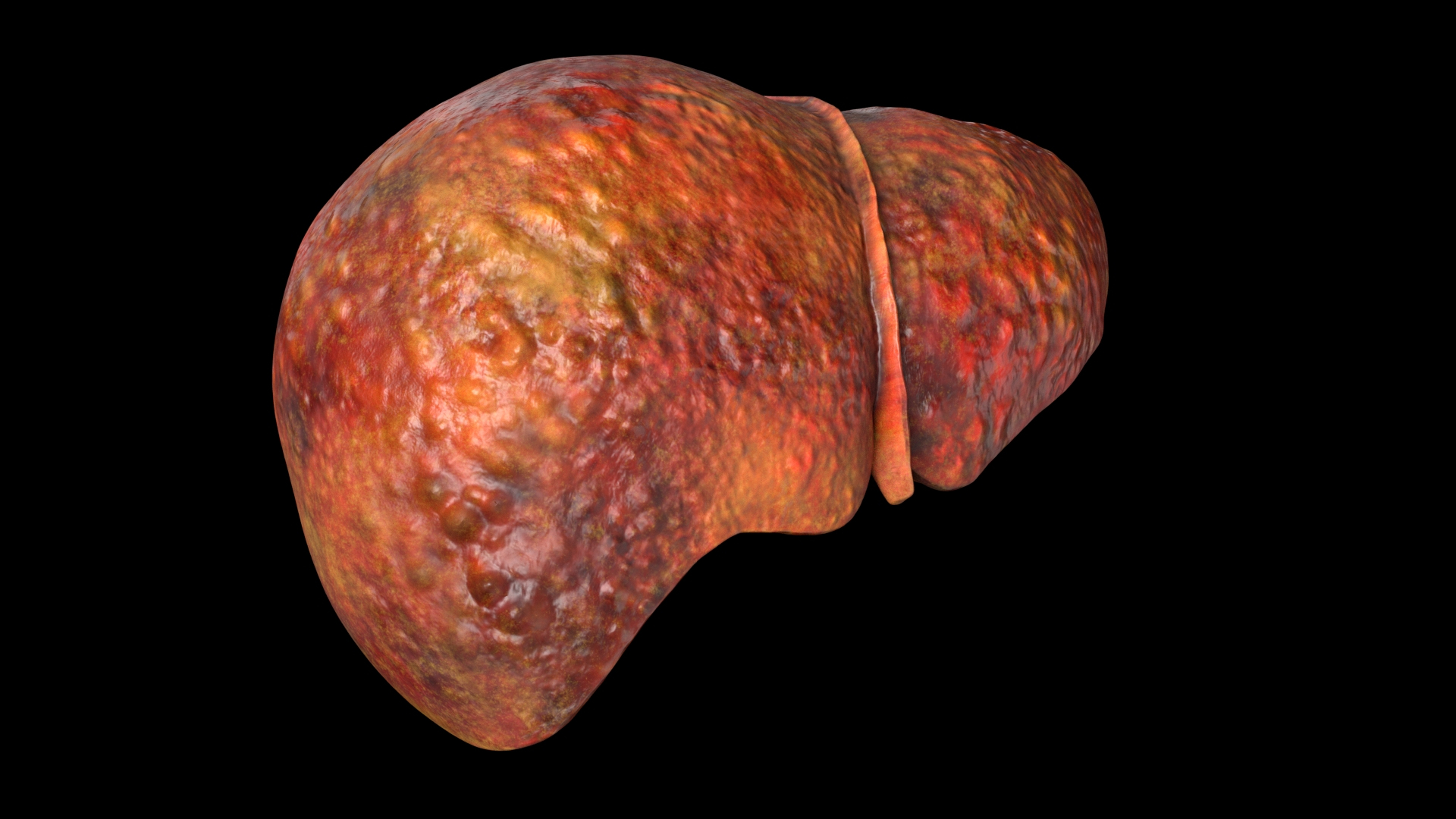 modelo 3d Hígado humano dañado - TurboSquid 1735319