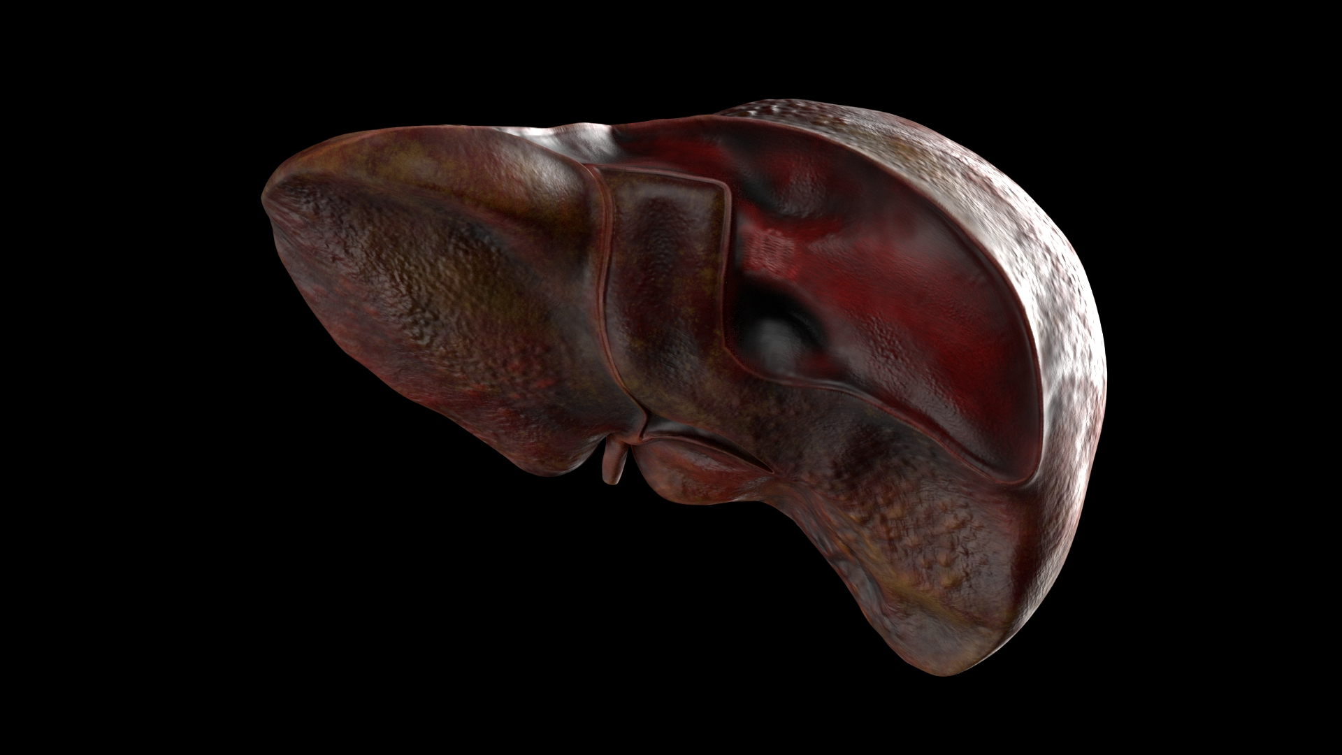 modelo 3d Hígado humano dañado - TurboSquid 1735319