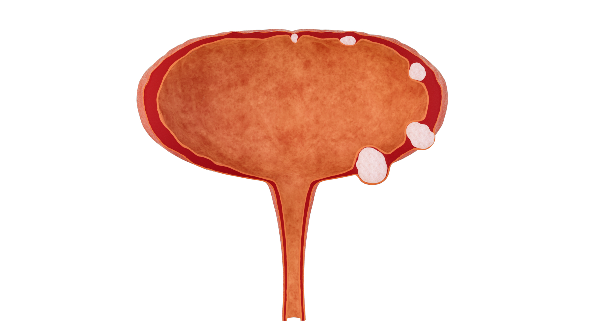 Bladder wall stones  bladder anatomy and lesions 3D https://p.turbosquid.com/ts-thumb/pH/1ZUOAc/nN/pm/png/1770371150/1920x1080/turn_fit_q99/0b3cf1dee7558e1dd3409eaceb9af969a5d36350/pm-1.jpg