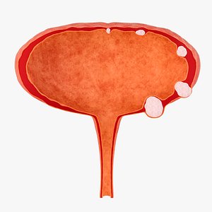 Bladder wall stones  bladder anatomy and lesions 3D