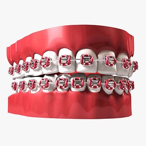 teeth braces 3d model