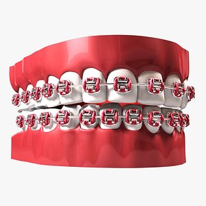 Teeth with Braces