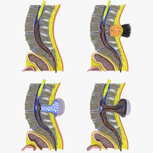 Spina bifida Neural Tube Defect 3D model