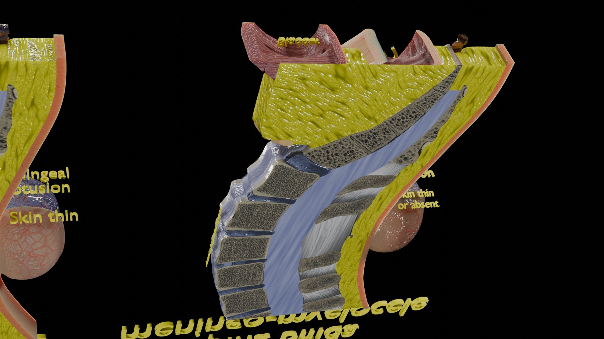 Spina bifida Neural Tube Defect 3D model https://p.turbosquid.com/ts-thumb/pi/sa5DPR/28/aa0069/jpg/1742531966/1920x1080/fit_q87/22b43b703090253c7458fcbeb170d3956b7c6652/aa0069.jpg