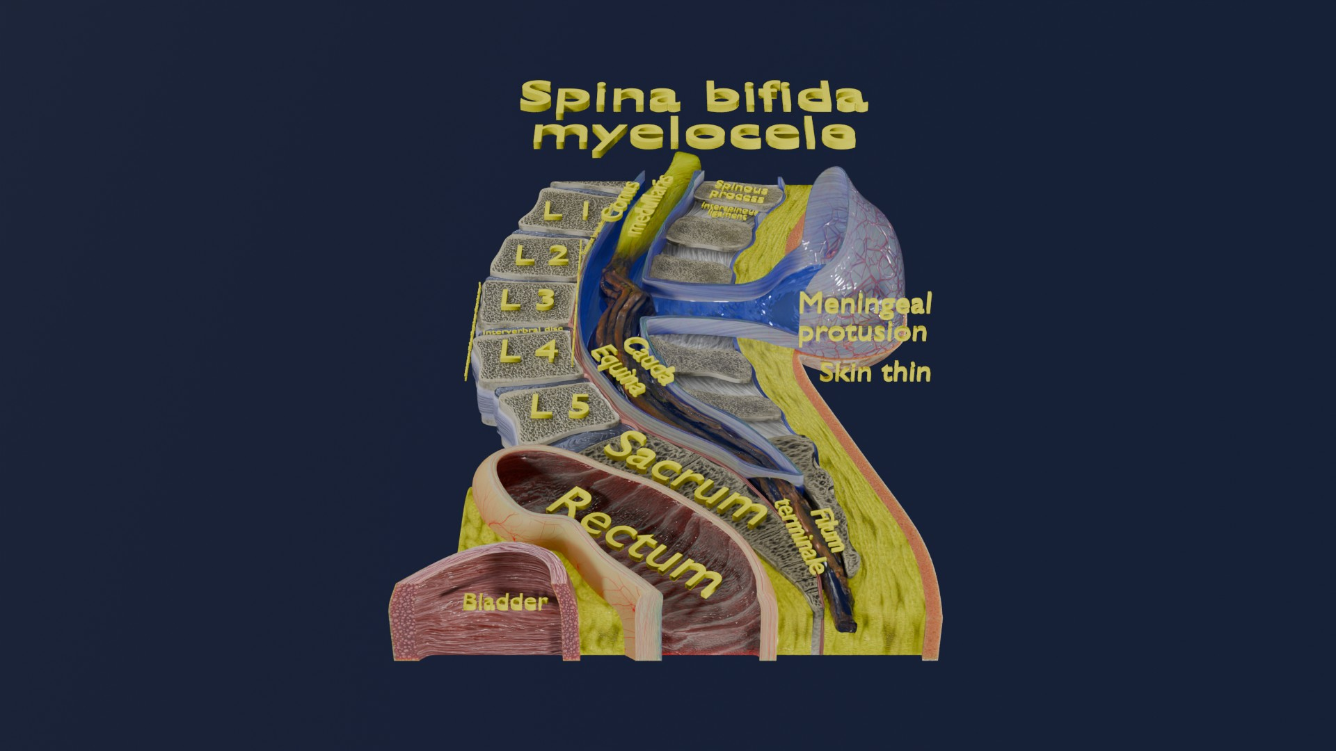 Spina bifida Neural Tube Defect 3D model https://p.turbosquid.com/ts-thumb/pi/sa5DPR/3j/meni/jpg/1742533260/1920x1080/turn_fit_q99/c52e9637164832e8bfd60a31f521ada98520521d/meni-1.jpg
