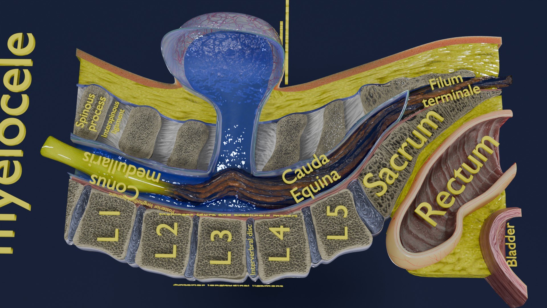 Spina bifida Neural Tube Defect 3D model https://p.turbosquid.com/ts-thumb/pi/sa5DPR/9g/aa0046/jpg/1742531898/1920x1080/fit_q87/a42f22d78efa33ec70845a99bfeb5ba2304c5ebe/aa0046.jpg