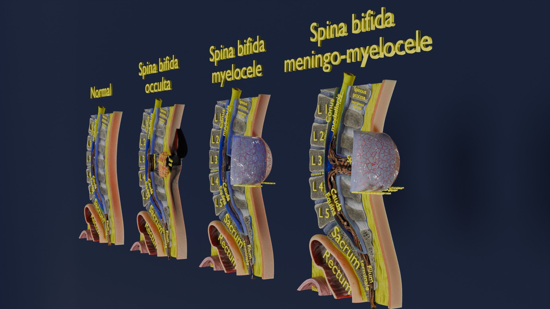 Spina bifida Neural Tube Defect 3D model https://p.turbosquid.com/ts-thumb/pi/sa5DPR/Ch/aa0007/jpg/1742531808/1920x1080/fit_q87/ae56b90326a8703f112997196f6c26b7c217475f/aa0007.jpg
