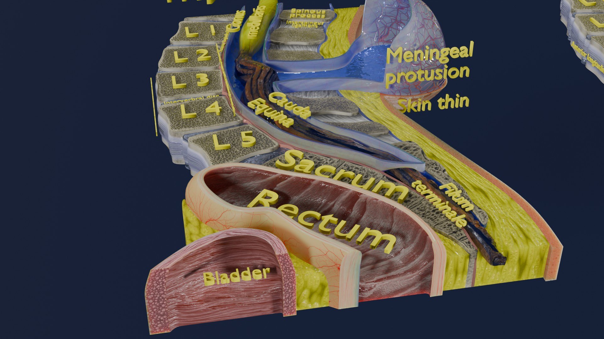 Spina bifida Neural Tube Defect 3D model https://p.turbosquid.com/ts-thumb/pi/sa5DPR/DM/aa0043/jpg/1742531896/1920x1080/fit_q87/9d039fe1b41827258bd99b9e681cae362fc664cb/aa0043.jpg