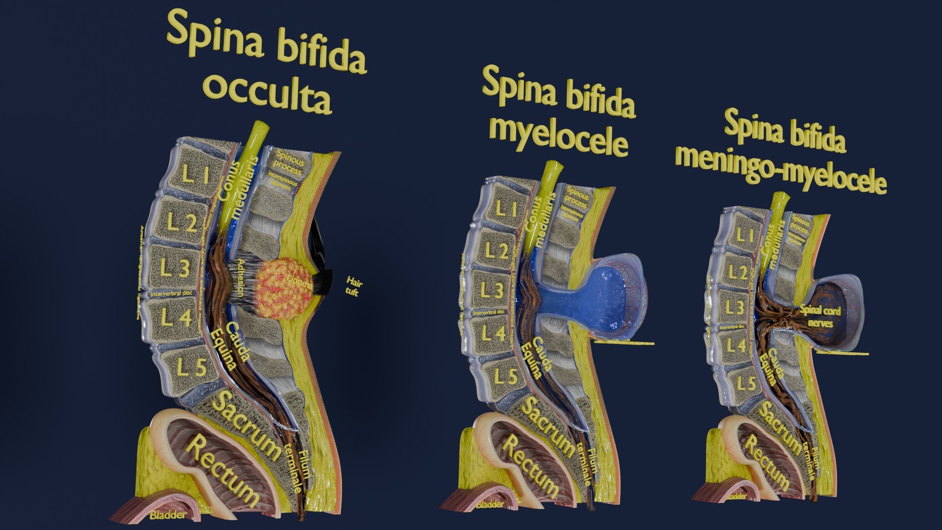 Spina bifida Neural Tube Defect 3D model https://p.turbosquid.com/ts-thumb/pi/sa5DPR/EA/aa0005/jpg/1742531880/1920x1080/fit_q87/aafd31aa7078b20004d0d1df38570c0e8405f51d/aa0005.jpg