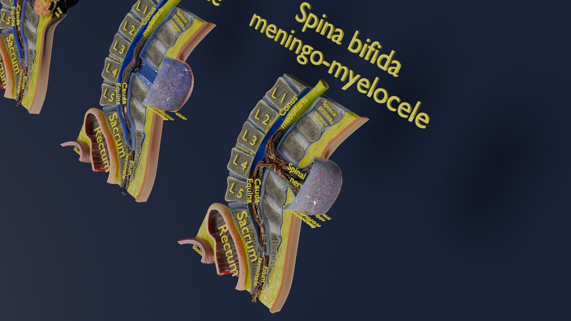 Spina bifida Neural Tube Defect 3D model https://p.turbosquid.com/ts-thumb/pi/sa5DPR/Hr/aa0058/jpg/1742531930/1920x1080/fit_q87/e68d18dc1e1fe18a237e1efcf8264949782cbf3a/aa0058.jpg