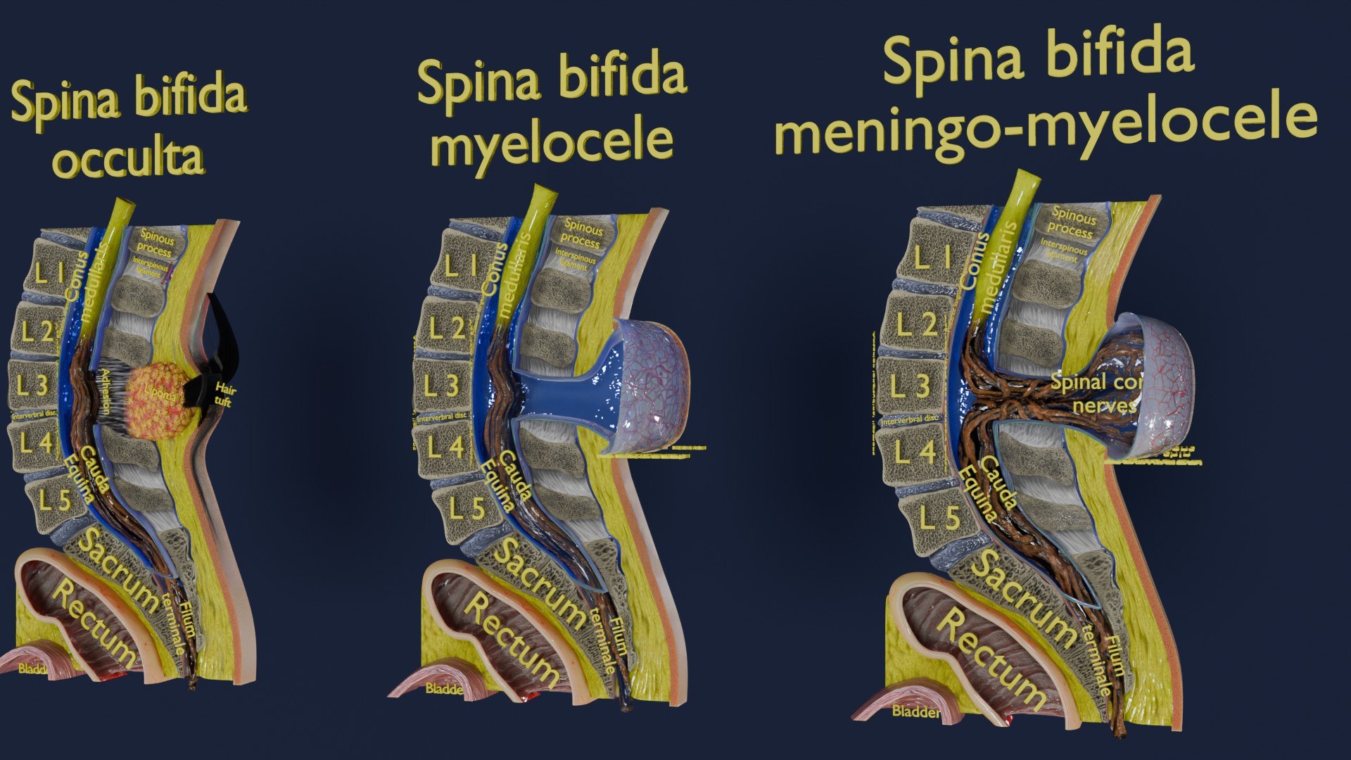 Spina bifida Neural Tube Defect 3D model https://p.turbosquid.com/ts-thumb/pi/sa5DPR/Ks/aa0006/jpg/1742531807/1920x1080/fit_q87/3b497db7c2e63a0df5d3036f0e3abd30173a0cb1/aa0006.jpg