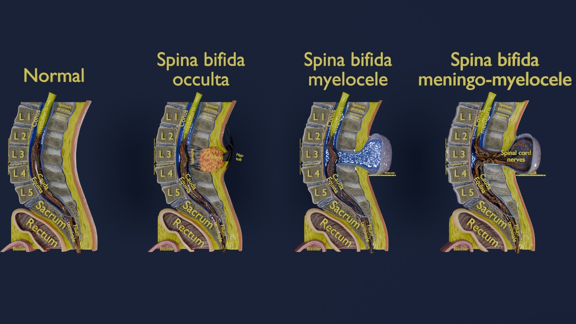 Spina bifida Neural Tube Defect 3D model https://p.turbosquid.com/ts-thumb/pi/sa5DPR/L5/aa0001/jpg/1742531802/1920x1080/fit_q87/8a7ed1d984ee04c12eb27d3b0fba8fddc5dc7616/aa0001.jpg