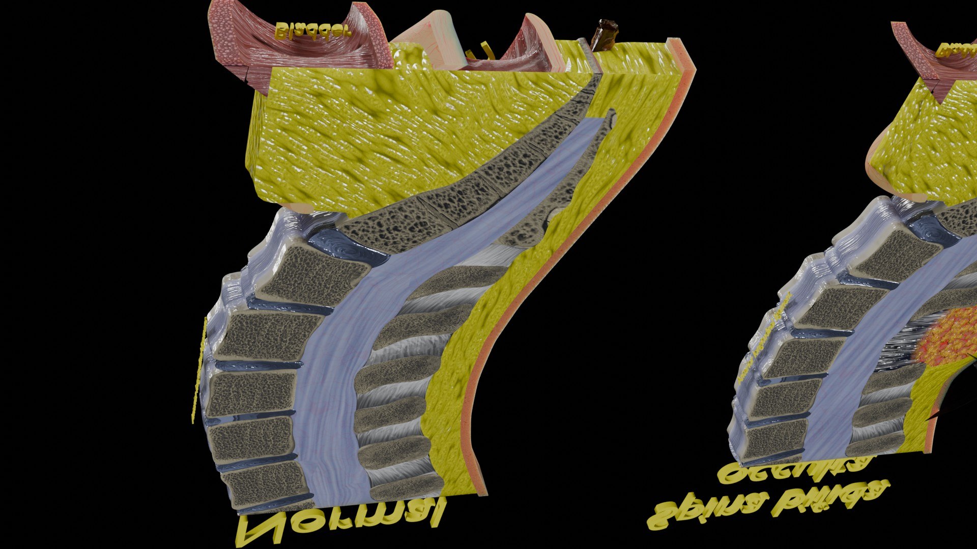 Spina bifida Neural Tube Defect 3D model https://p.turbosquid.com/ts-thumb/pi/sa5DPR/LR/aa0022/jpg/1742531843/1920x1080/fit_q87/8f8a5d16de144a1bec024baca93ebb5c8bc9db50/aa0022.jpg