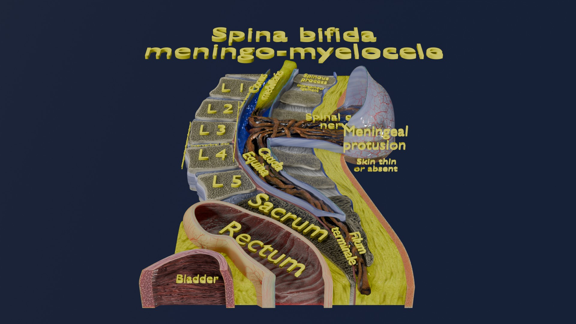 Spina bifida Neural Tube Defect 3D model https://p.turbosquid.com/ts-thumb/pi/sa5DPR/NG/spin/jpg/1742533285/1920x1080/turn_fit_q99/60fad313beeceaa489e6d7e238a181eaa5ae4029/spin-1.jpg