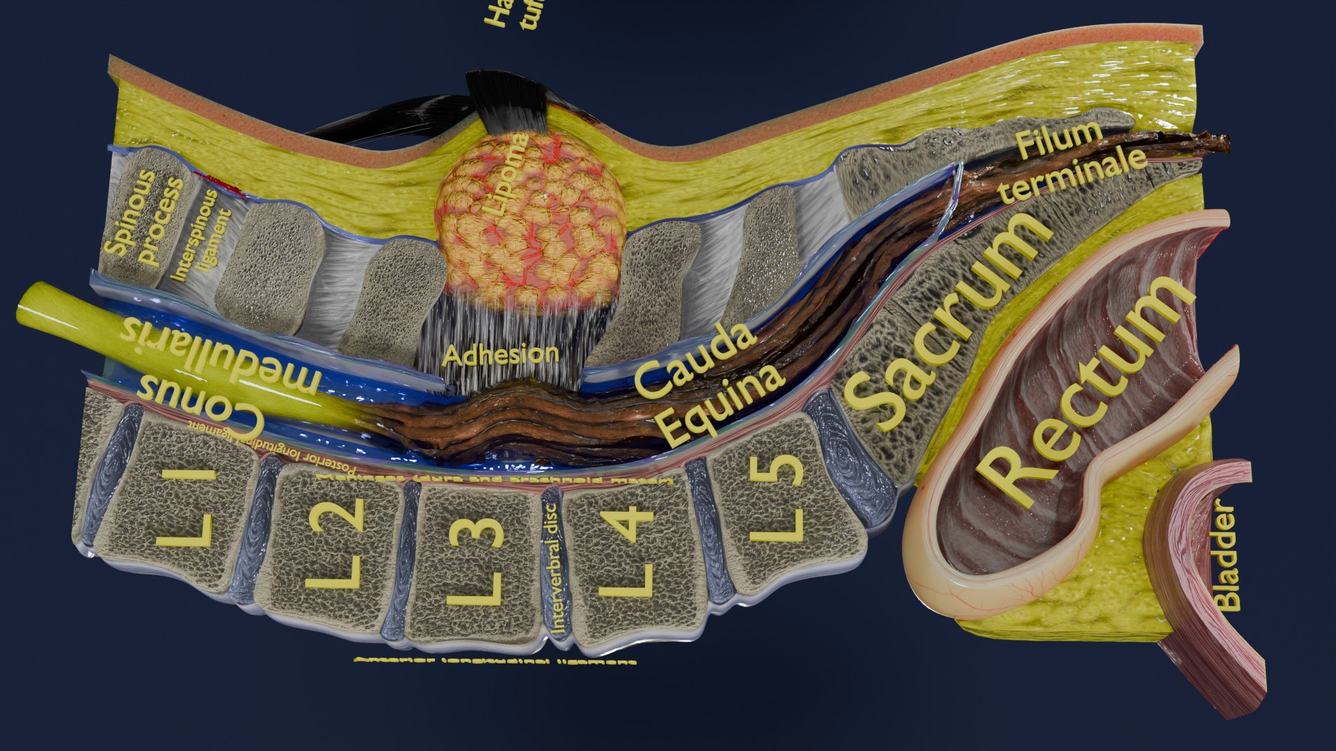 Spina bifida Neural Tube Defect 3D model https://p.turbosquid.com/ts-thumb/pi/sa5DPR/NW/aa0028/jpg/1742531859/1920x1080/fit_q87/375a82a61d4e3e2416556e90f5b89ab17534b5bc/aa0028.jpg