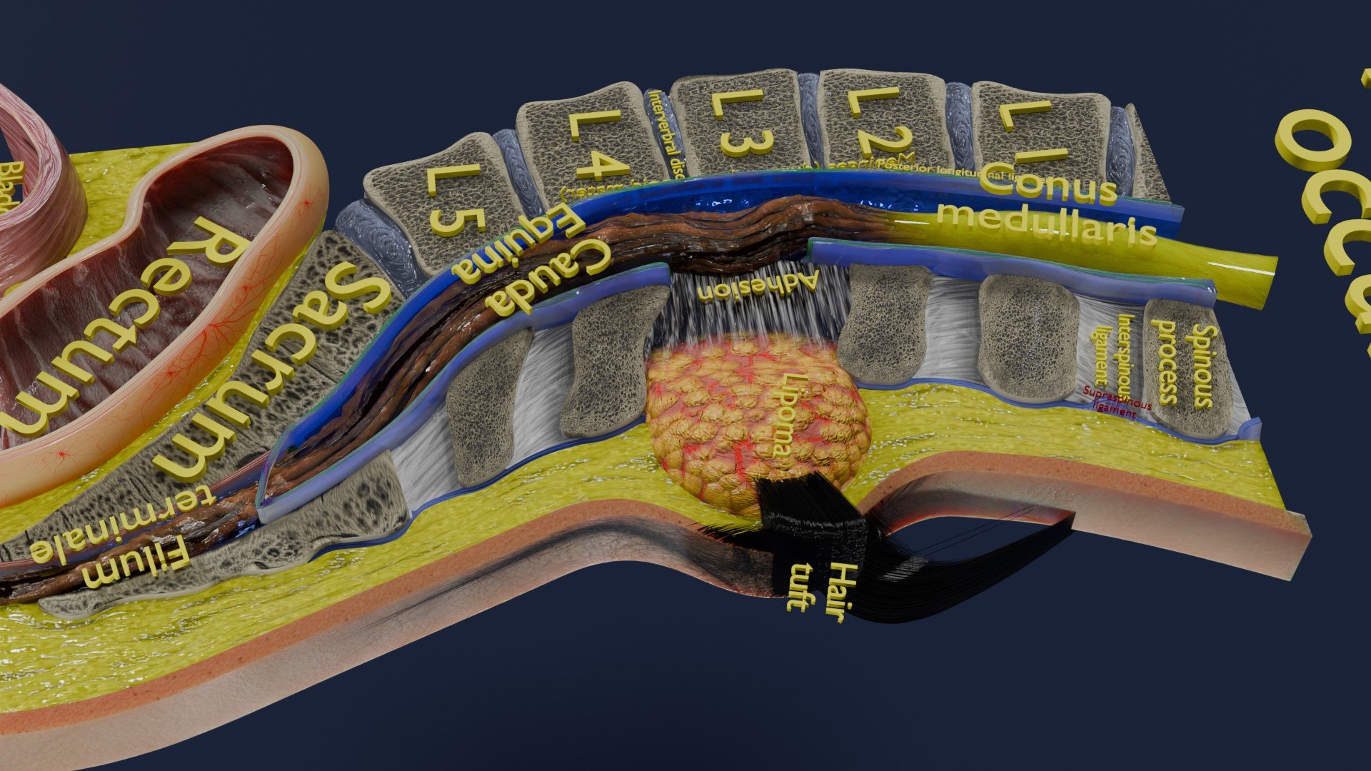 Spina bifida Neural Tube Defect 3D model https://p.turbosquid.com/ts-thumb/pi/sa5DPR/On/aa0031/jpg/1742531868/1920x1080/fit_q87/8be6d0065c1b2fe17f5aafcd8f6cc22864863c9a/aa0031.jpg