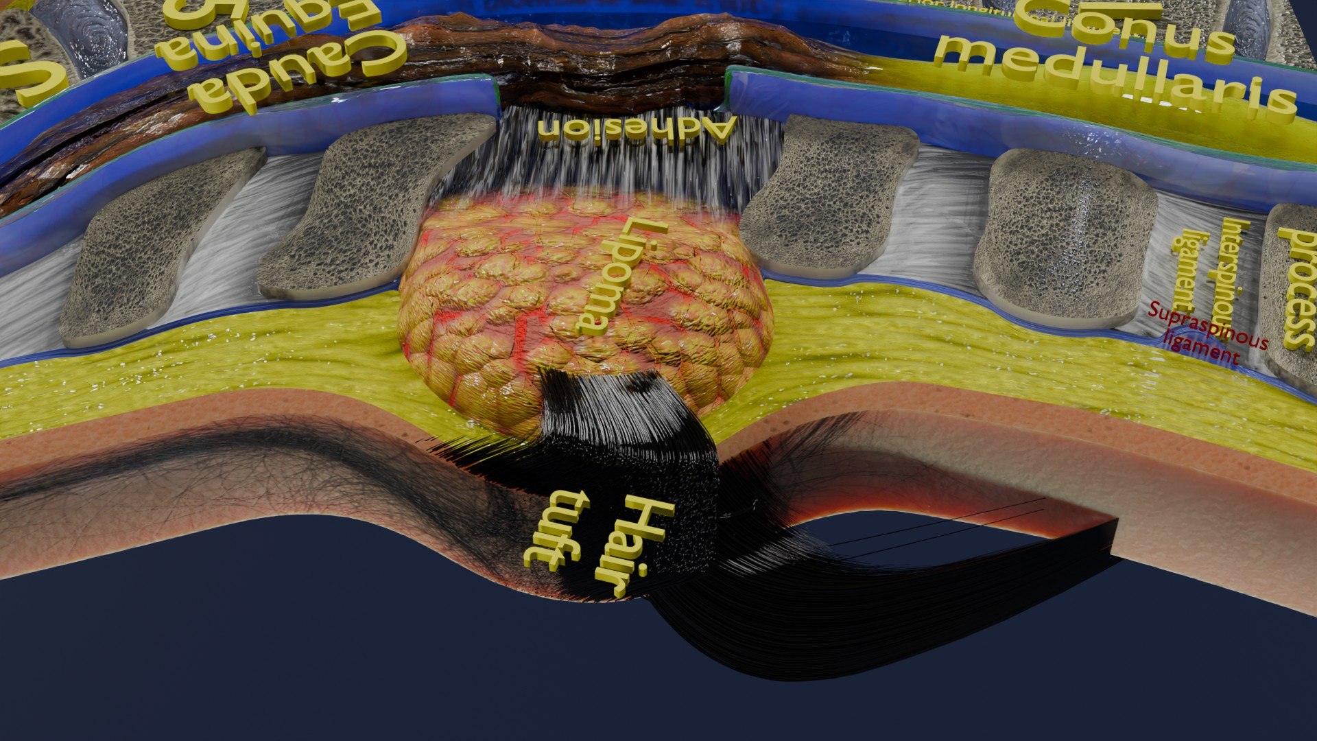 Spina bifida Neural Tube Defect 3D model https://p.turbosquid.com/ts-thumb/pi/sa5DPR/Qu/aa0032/jpg/1742531872/1920x1080/fit_q87/4d92f95ffe121c4a834eeb9812174e0177dfca57/aa0032.jpg