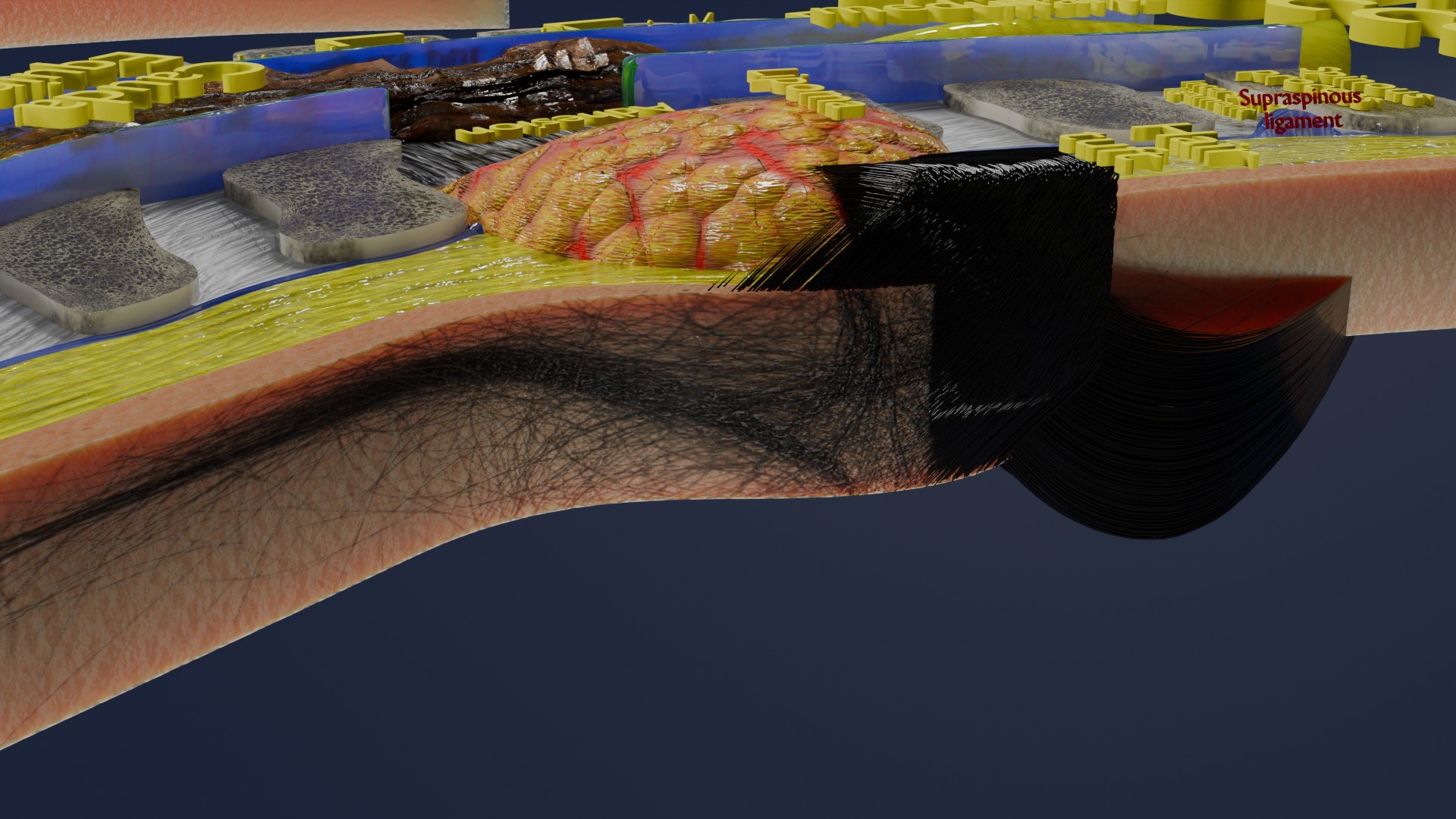 Spina bifida Neural Tube Defect 3D model https://p.turbosquid.com/ts-thumb/pi/sa5DPR/T9/aa0034/jpg/1742531876/1920x1080/fit_q87/6acdffd25066507f76ec0f7d928f2c74490ed84a/aa0034.jpg