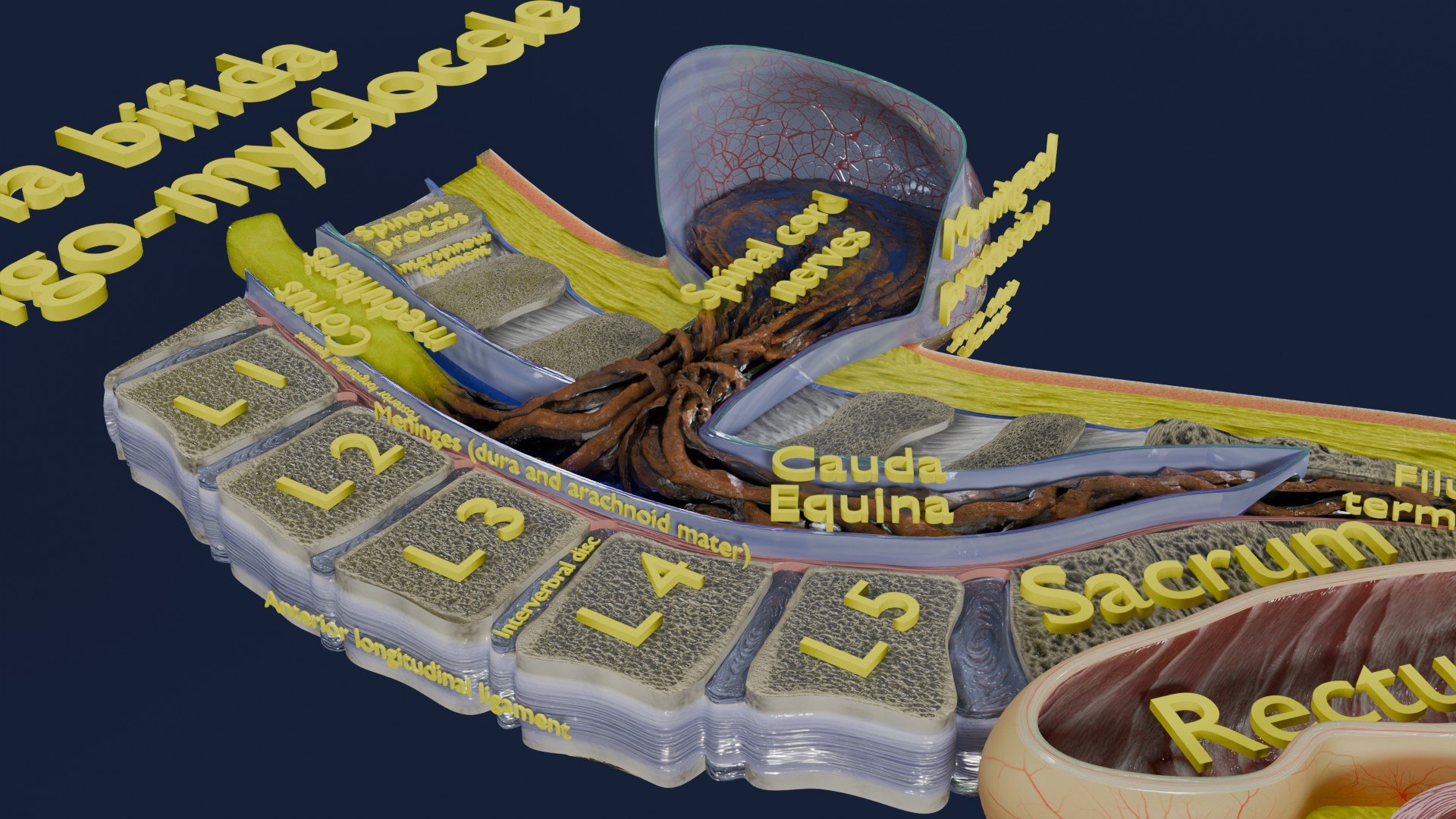 Spina bifida Neural Tube Defect 3D model https://p.turbosquid.com/ts-thumb/pi/sa5DPR/UJ/aa0061/jpg/1742531940/1920x1080/fit_q87/a2e70258984d79950e1d61b1a511a48b5937a0a1/aa0061.jpg