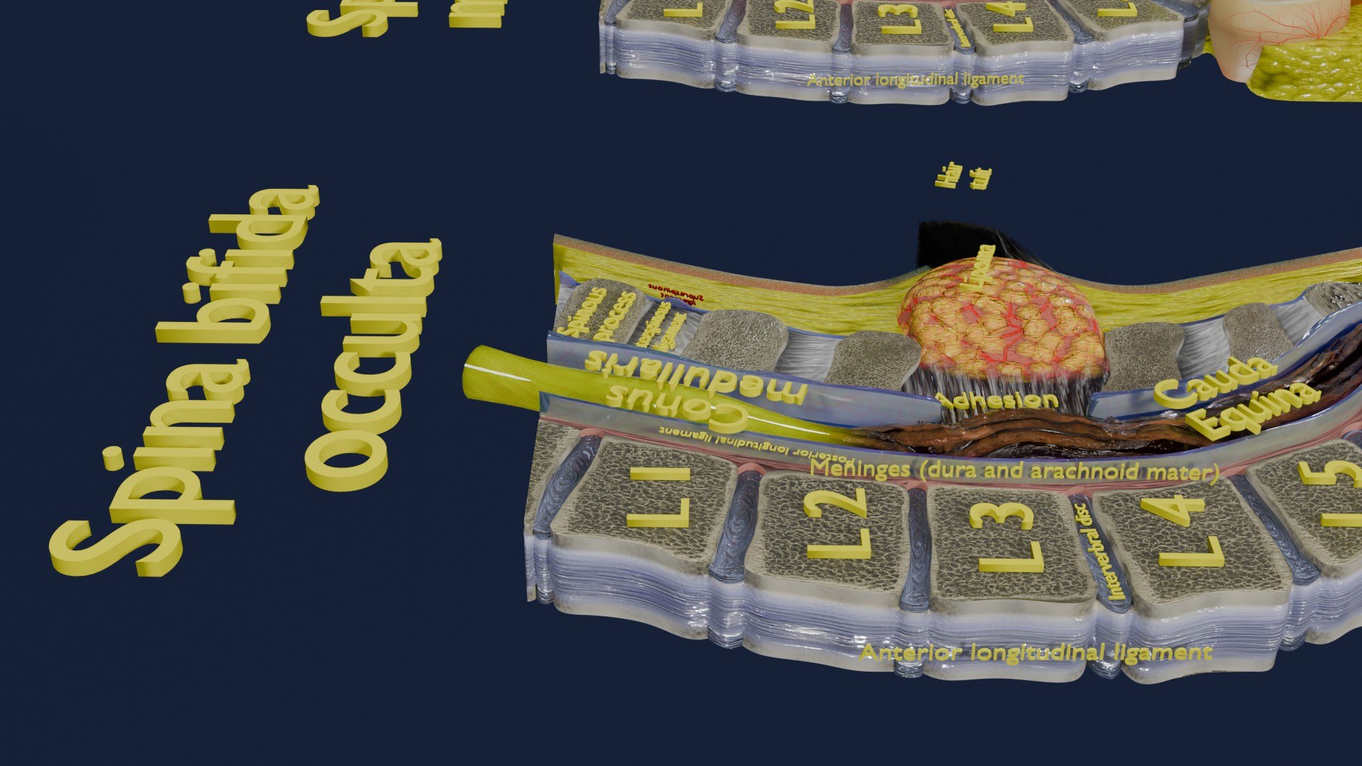 Spina bifida Neural Tube Defect 3D model https://p.turbosquid.com/ts-thumb/pi/sa5DPR/Up/aa0027/jpg/1742531856/1920x1080/fit_q87/85e216299f5d69c46b73fbf0c59ff27fd769c228/aa0027.jpg