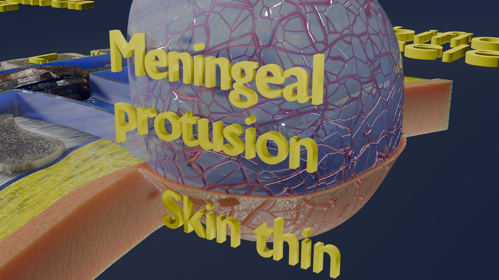 Spina bifida Neural Tube Defect 3D model https://p.turbosquid.com/ts-thumb/pi/sa5DPR/WM/aa0052/jpg/1742531917/1920x1080/fit_q87/4a987a131e12d74517e9724270226abbf35f8395/aa0052.jpg