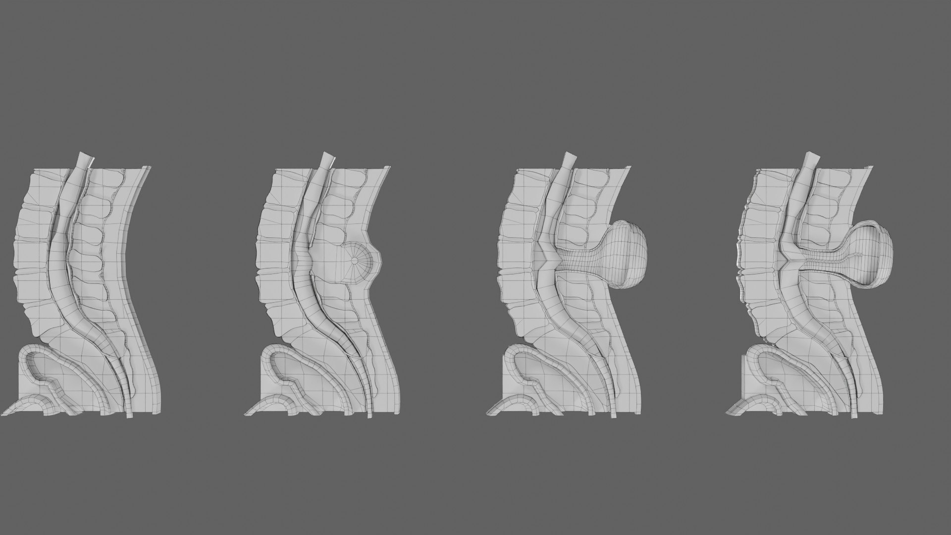 Spina bifida Neural Tube Defect 3D model https://p.turbosquid.com/ts-thumb/pi/sa5DPR/Zd/wf0001/jpg/1742531974/1920x1080/fit_q87/27ec4a582ca2fc0522e947a372f28679e2e84f8a/wf0001.jpg