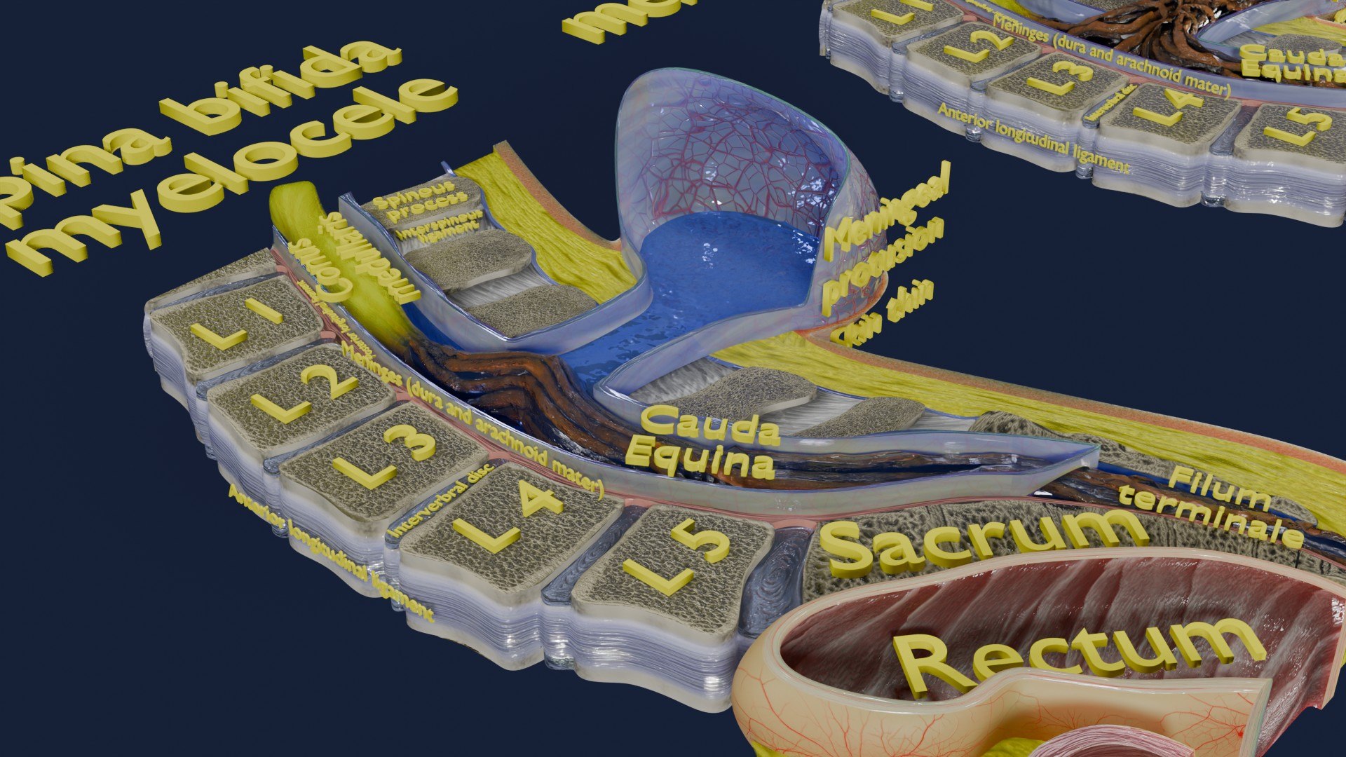 Spina bifida Neural Tube Defect 3D model https://p.turbosquid.com/ts-thumb/pi/sa5DPR/bp/aa0044/jpg/1742531982/1920x1080/fit_q87/746c65e74da0da350c0c7908c898847345a0ef92/aa0044.jpg