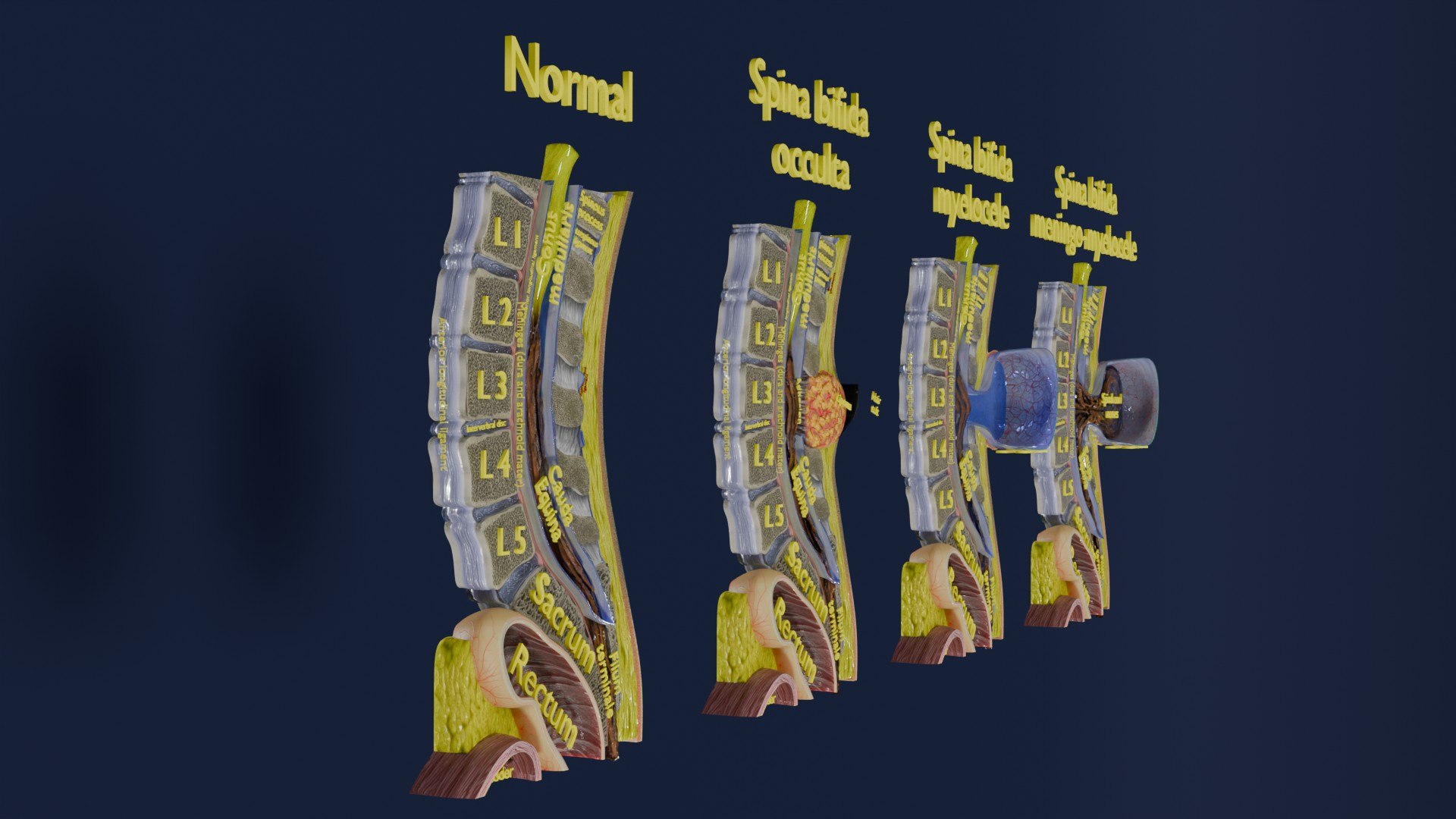 Spina bifida Neural Tube Defect 3D model https://p.turbosquid.com/ts-thumb/pi/sa5DPR/cC/aa0002/jpg/1742531802/1920x1080/fit_q87/aa095dadb7ff79cc4b134df810e9fc9fce114ba8/aa0002.jpg